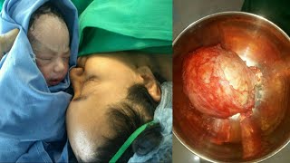 My Labour And Delivery Story C  Section with Myomectomy  Removal of large fibroids [upl. by Ulberto]