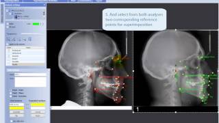 Making superimposition of two analyses in Planmeca Romexis® Cephalometric Analysis module [upl. by Eenyaj937]