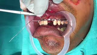 Arch Bar Fixation for Maxillary Dentoalveolar Fracture  Dr Sunil Richardson [upl. by Aivatal]