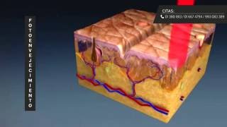 REGENERIS  Láser CO2 Fraccionado [upl. by Finkelstein824]