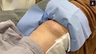 Huge Creamy Epidermal Cyst Incision and Drainage [upl. by Mccarthy]