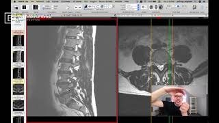 Clinical Series How to See a Pinched Nerve Foraminal Stenosis on MRI [upl. by Selyn]