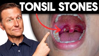 Tonsil Stones Removing the Deeper Cause [upl. by Kippie]