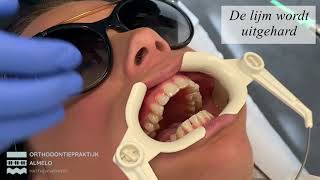 Plaatsen Invisalign beugel Orthodontiepraktijk Almelo [upl. by Flosser]