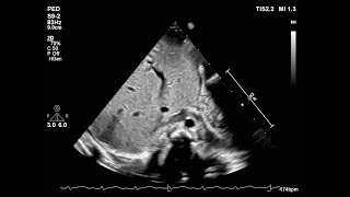 Basic Echocardiography심장 초음파 기본 Subcostal and apical 4 chamber view 자막 있음 [upl. by Ahcila]