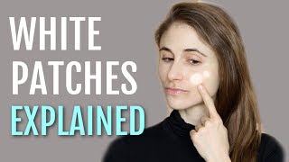 WHITE PATCHES ON THE FACE EXPLAINED PITYRIASIS ALBA DR DRAY [upl. by Sethrida]