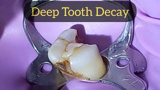 Deep Tooth Decay Removal Procedure  Premolar Caries Removal and Access Opening [upl. by Elmer114]