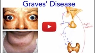 Graves Disease  Hyperthyroidism  Everything You Need to Know  MADE EASY [upl. by Florie580]