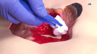 How to Effectively Cleanse and Debride a Wound  Wound Cleansing and Debridement  Ausmed Education [upl. by Spiegel]