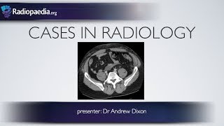 Cases in Radiology Episode 5 trauma CT abdomen [upl. by Ylurt600]