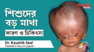 শিশুদের অতিরিক্ত বড় মাথা বা হাইড্রোসেফালাস কি কারণ ও চিকিৎসা  Hydrocephalus Baby Treatment [upl. by Tori]