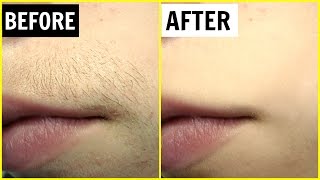 पाएं अनचाहे बालों से छुटकारा  Permanent Hair Removal  Anaysa [upl. by Xantha]