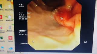 Precut sphincterotomy made easy Malignant EHBO ERCP [upl. by Tomlin]