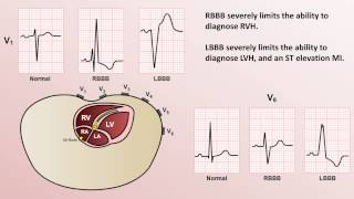 Intro to EKG Interpretation  Bundle Branch Blocks [upl. by Llewen360]