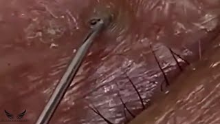 Severe Eye Blackhead Removal  Acne Cystic Treatment  Pimple Popping Elderly Acne Spa Remove  062 [upl. by Sheila]