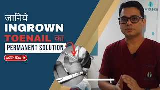 Ingrown Toenail Surgery  Nail Surgery Clinic in Delhi Ingrown Toenail Removal in Delhi SkinQure [upl. by Dexter]