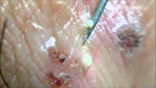 Cyst drainage of the lot [upl. by Yllut448]