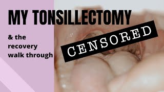 MY TONSILLECTOMY Daybyday recovery walkthrough [upl. by Akanke]