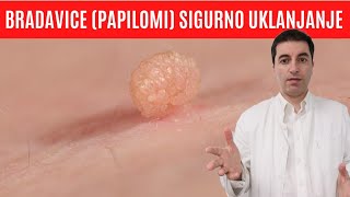 BRADAVICE PAPILOMI jednostavno i sigurno UKLANJANJE prirodnim putem [upl. by Novej]