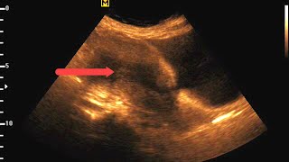 Leiomyosarcoma  Ultrasound Cases 4 of 2000 [upl. by Enairda]