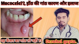 Mucocele होंठ की गांठ के कारण और इलाज  Treatment of Mucocele in hindi  rk about medicine [upl. by Latsryk879]