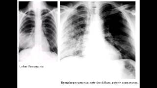 Lobar Pneumonia amp Bronchopneumonia  Organisms amp Characteristics [upl. by Garnette]