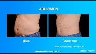 CoolSculpting NonSurgical Fat Reduction  Avie Medspa amp Laser Center  Leesburg VA [upl. by Sauers192]