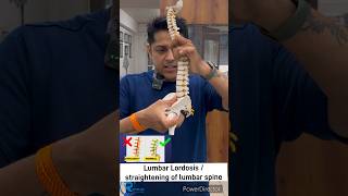 कमर दर्द क्यो होता है।जाने loss of lumbar lordosis क्या होता है। backpainkamardard lowbackpain [upl. by Freida443]