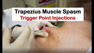 Trapezius Muscle Spasm Trigger Point Injection [upl. by Janene]