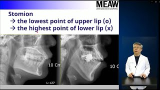 7Cephalometric landmarks Part 2 [upl. by Ruttger698]