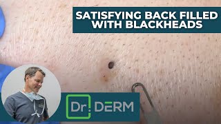 Satisfying Back Filled with Blackheads  Dr Derm [upl. by Sicnarf]