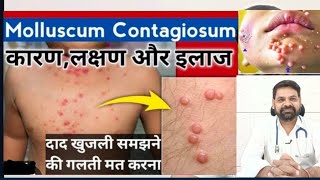 Molluscum contagiosum in hindi  Molluscum contagiosum treatment  Molluscum contagiosum [upl. by Annayt]