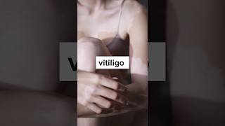 What is Vitiligo and how to stop it Get to know everything with Skinaa Clinic shorts viral [upl. by Vally]