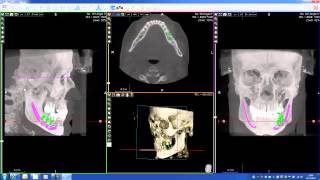 3D Cephalometric module with AIS software made by Acteon for CBCT Cone beam [upl. by Heise471]