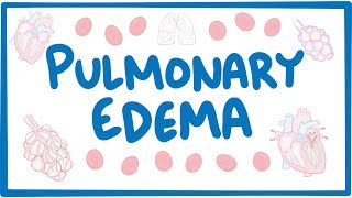 Pulmonary Edema  causes symptoms diagnosis treatment pathology [upl. by Becht480]