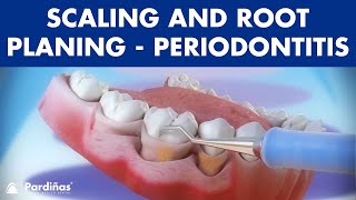 Treatment of periodontal disease  Scaling and root planing  Tartar © [upl. by Kcirreg389]