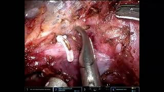 Dissection of the segment 2 and 3 pedicles in the umbilical fissure [upl. by Adiraf]