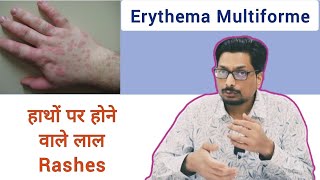 हाथों पर होने वाले लाल Rashes  Erythema Multiforme  Red Rashes hand feet mouth rashes herpes [upl. by Karame798]