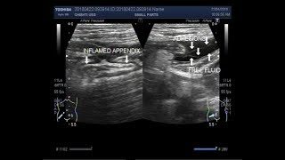 Ultrasound Video showing a leakage from the ruptured Appendix [upl. by Eilegna]