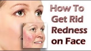 How To Reduce Redness On Face  3 Easy Steps  Acne Prone Skin Care  Bhavya Glam Girl [upl. by Nunnery]