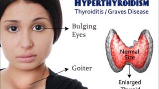 ഹൈപ്പർതൈറോയ്ഡ് ലക്ഷണങ്ങൾ Hyperthyroidism symptoms and diet in Malayalam [upl. by Assilav]