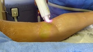 Laser Hair Removal at MediZen Clinic in Birmingham for legs face and body [upl. by Yadrahs]