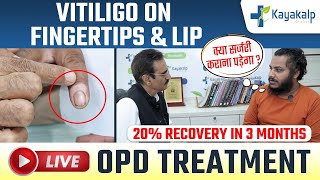 Vitiligo on Lips amp Fingertips  Safed Daag Recovery in 3 Months Cream for vitiligo Kayakalp Global [upl. by Kowtko]