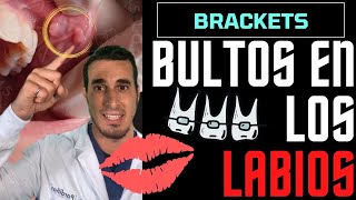 🧐Esto le salió en los LABIOS por los BRACKETS de una ORTODONCIA [upl. by Eenafets37]