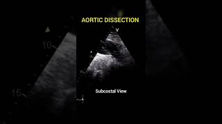 Aortic Dissection with freeflow between True and False Lumen echocardiography [upl. by Calvina350]