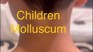 Children Molluscum treatment Don’t worry Just Don’t manipulate and scratch or cryo or acid [upl. by Aivun]