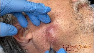 Drainage of an infected cyst along the jaw line [upl. by Terrag789]