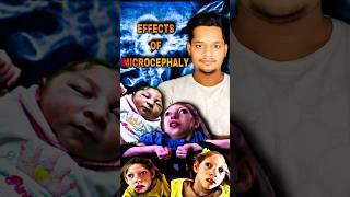 What is Microcephaly  Effects of Microcephaly  microcephaly india shorts facts ytshortsindia [upl. by Jarus916]