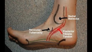 Posterior Tibial Tendinitis Evaluation with Paul Marquis PT [upl. by Swartz]