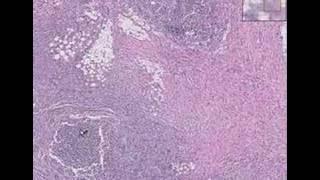 Histopathology GutActinomycosis diverticulitis abscess [upl. by Margaretta]